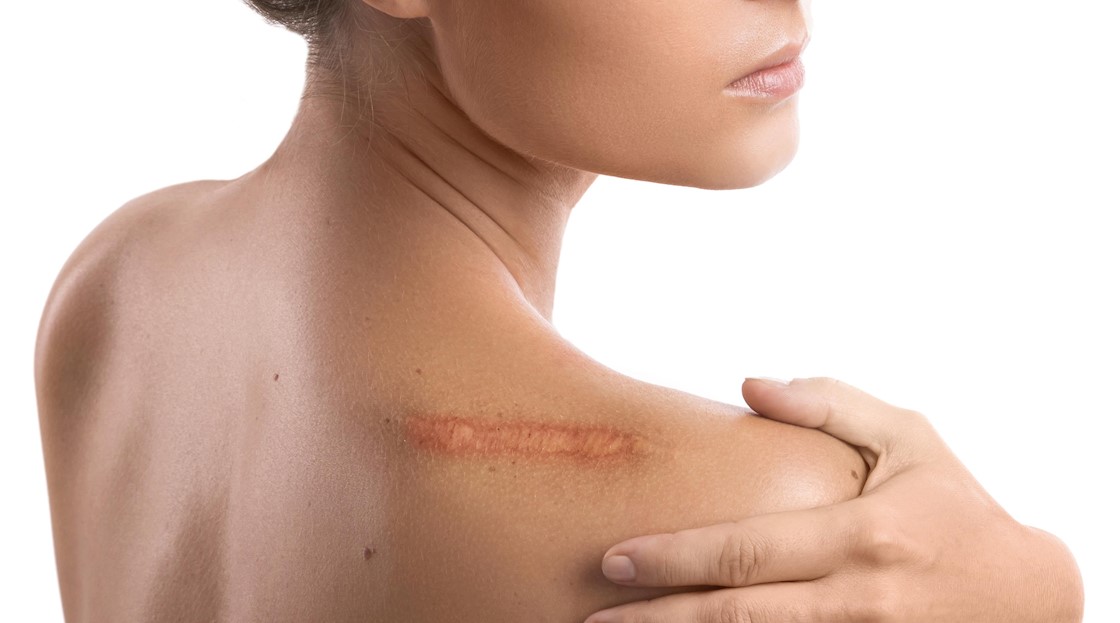 Scar Erase announces silicone strip solution for scars in the UK