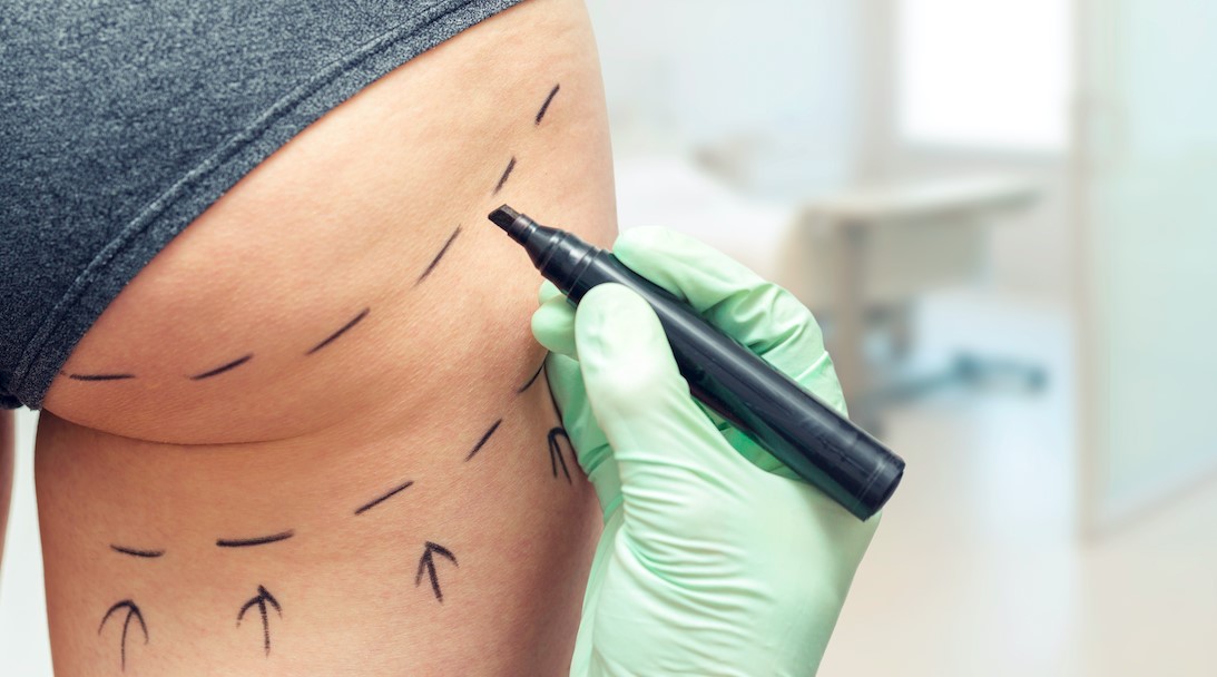 Buttock surgery sees highest growth of all surgical procedures in 2019