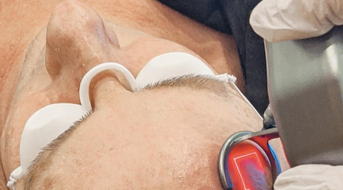 Sponsored news: The benefits of CO2 laser resurfacing