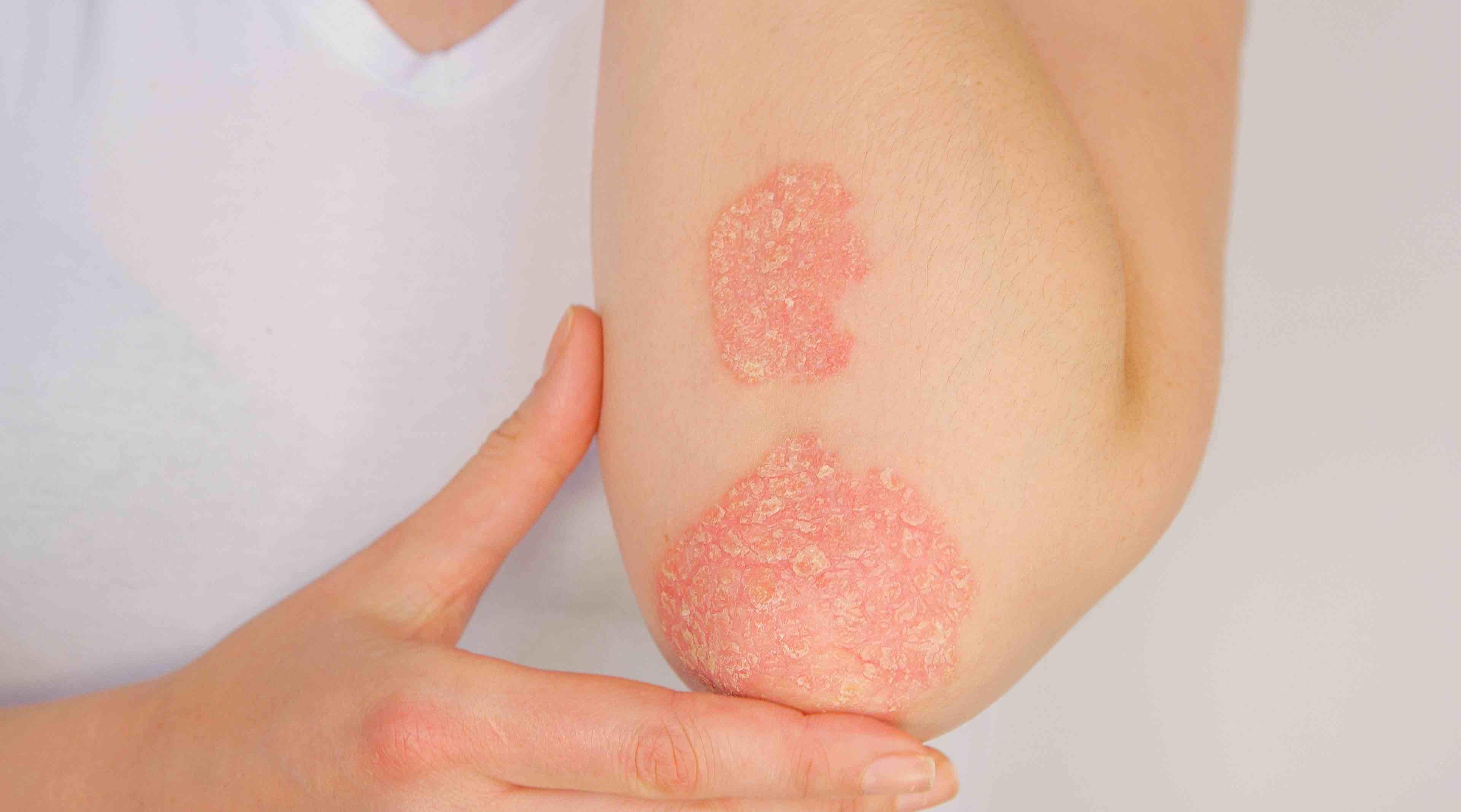 New method of determining psoriasis severity announced 