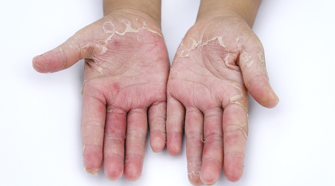 Coronavirus leads to increase in eczema among children