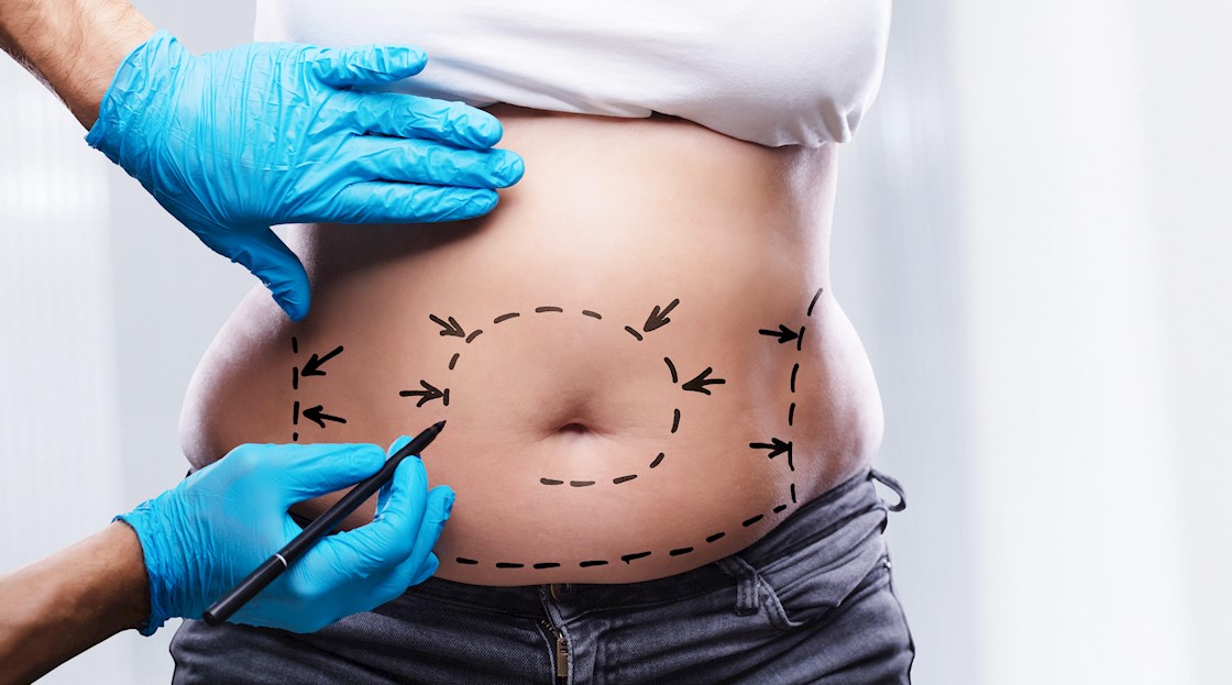 A six-step patient assessment plan for abdominoplasty and liposuction
