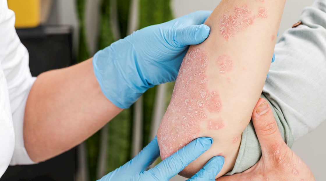 Intermittent fasting found to reduce psoriasis severity