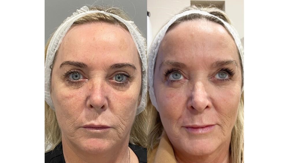 Using Sukenos for clients with negative injectable experiences