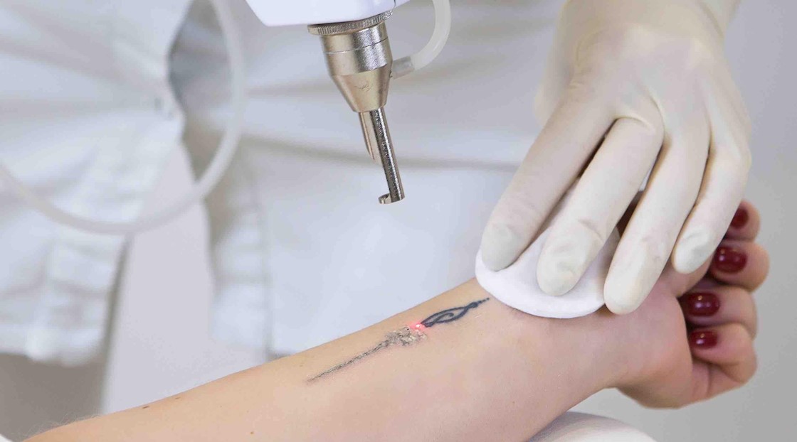 1064nm lasers prove most effective for tattoo removal in study