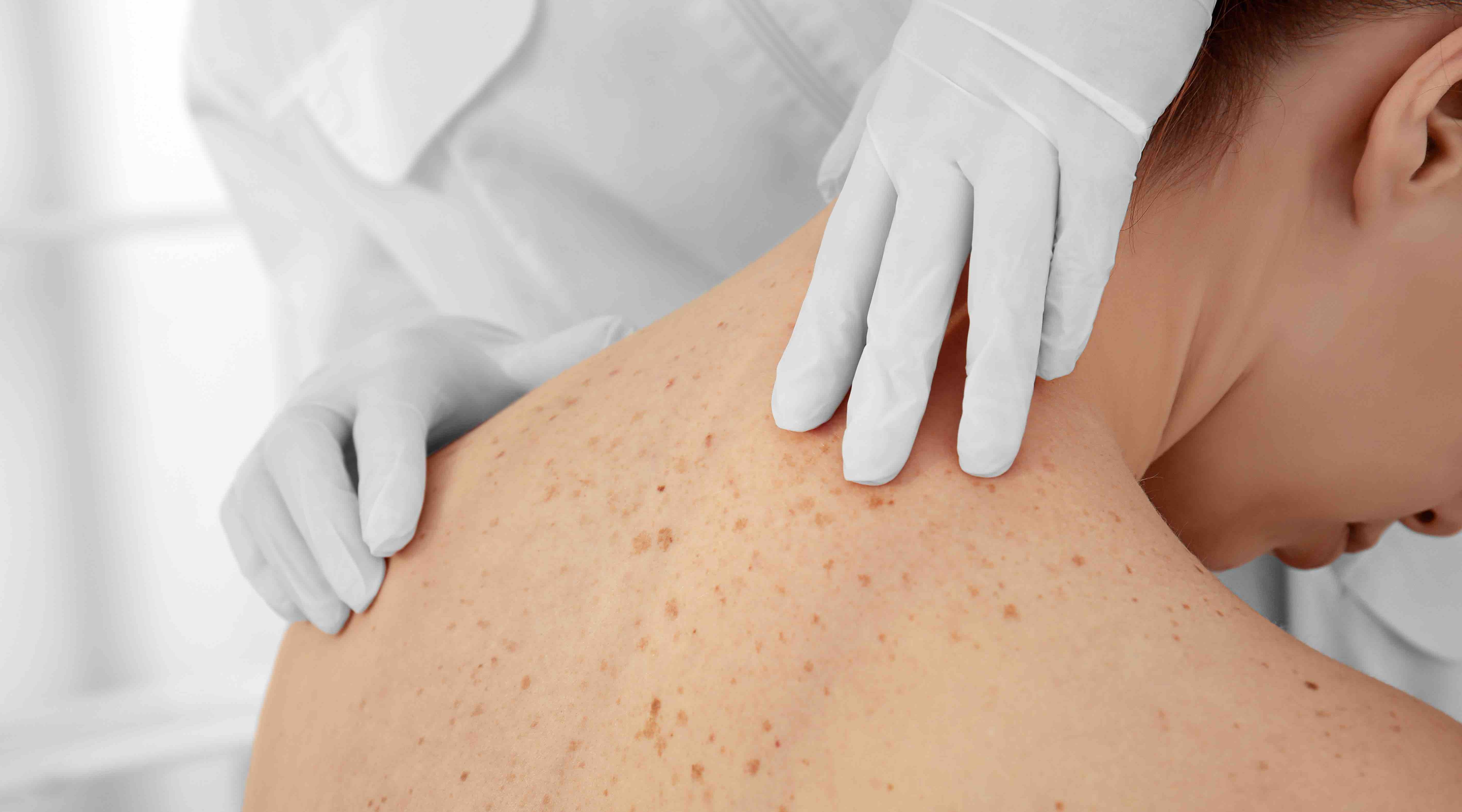 Dr Nick Lowe advises on acquired pigment lesions – when to treat and when to refer