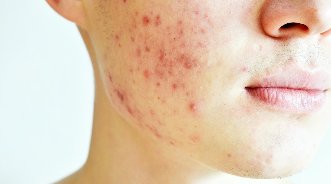 Non-invasive device gains FDA clearance