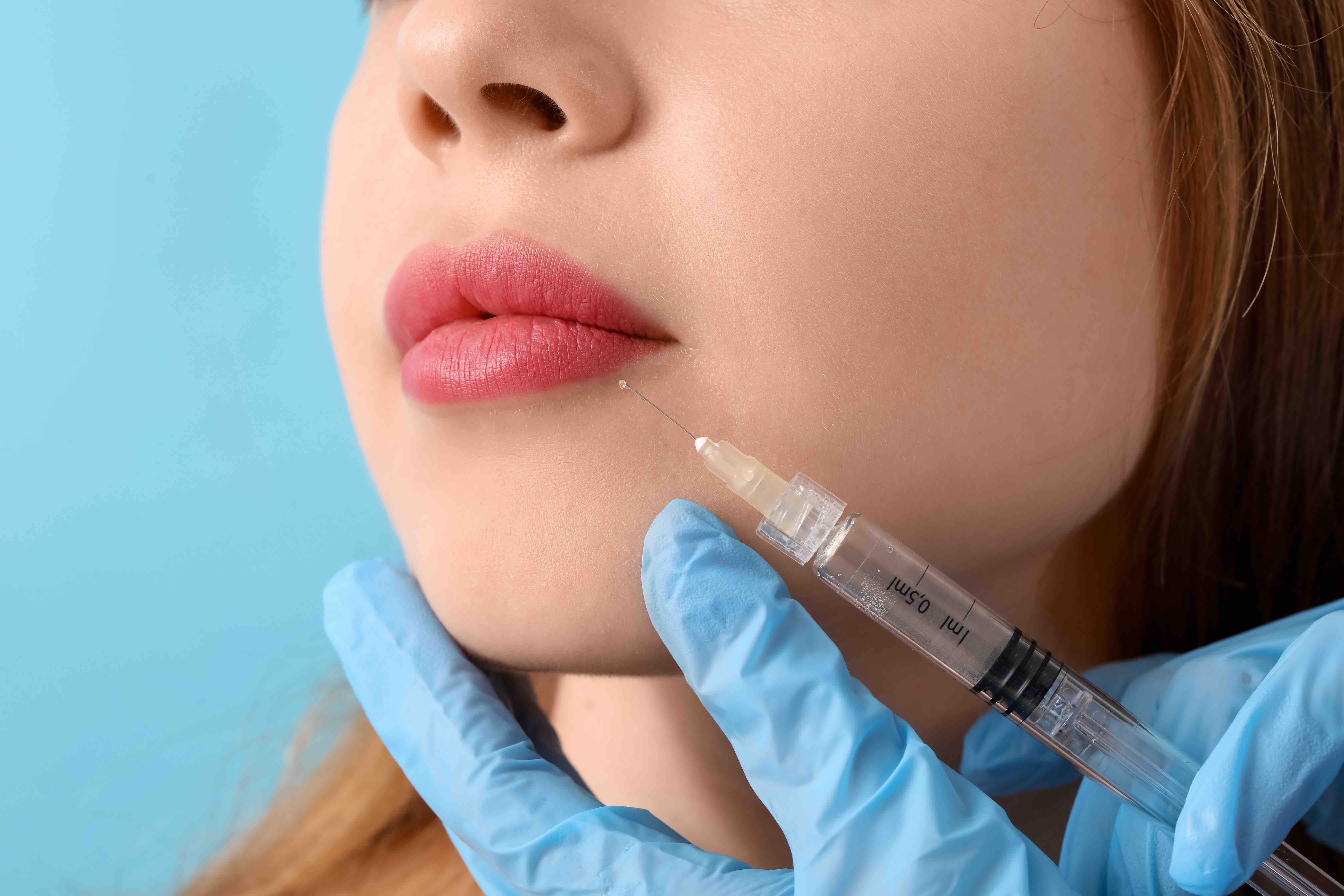 Lips and nasolabial folds revealed as two most popular dermal filler treatment areas