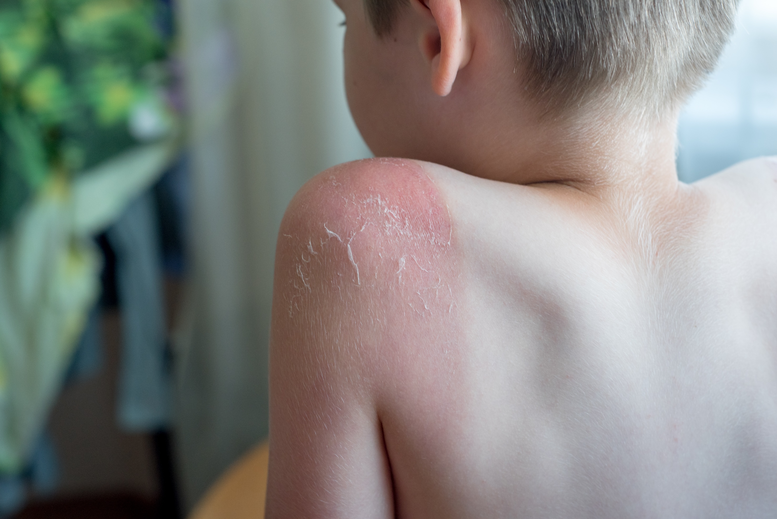 Survey reveals alarming sunburn rates among UK children, putting future skin health at risk