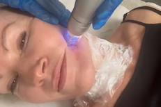 Treatment review: Scarlet RF