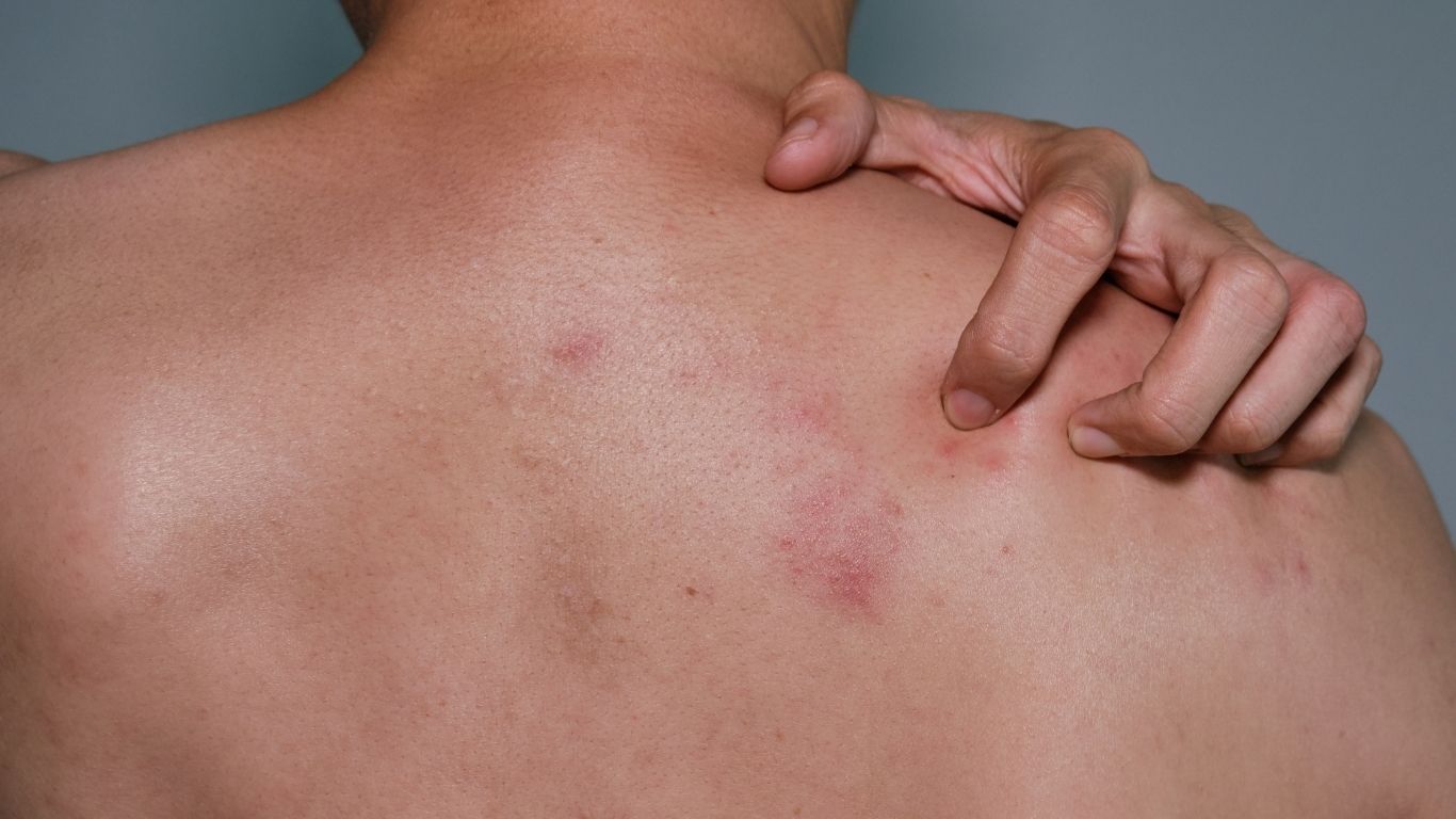 How to treat and prevent body acne