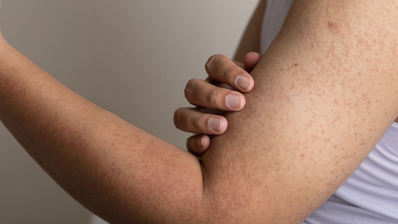 What is keratosis pilaris and how can it be treated?
