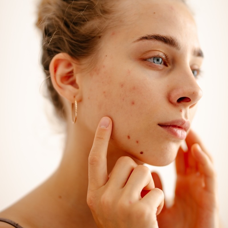 The skin’s immune system: how inflammation starts and how therapists can support it