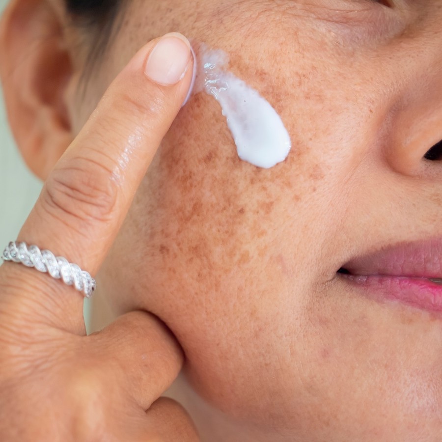 Everything you need to know about azelaic acid in skincare