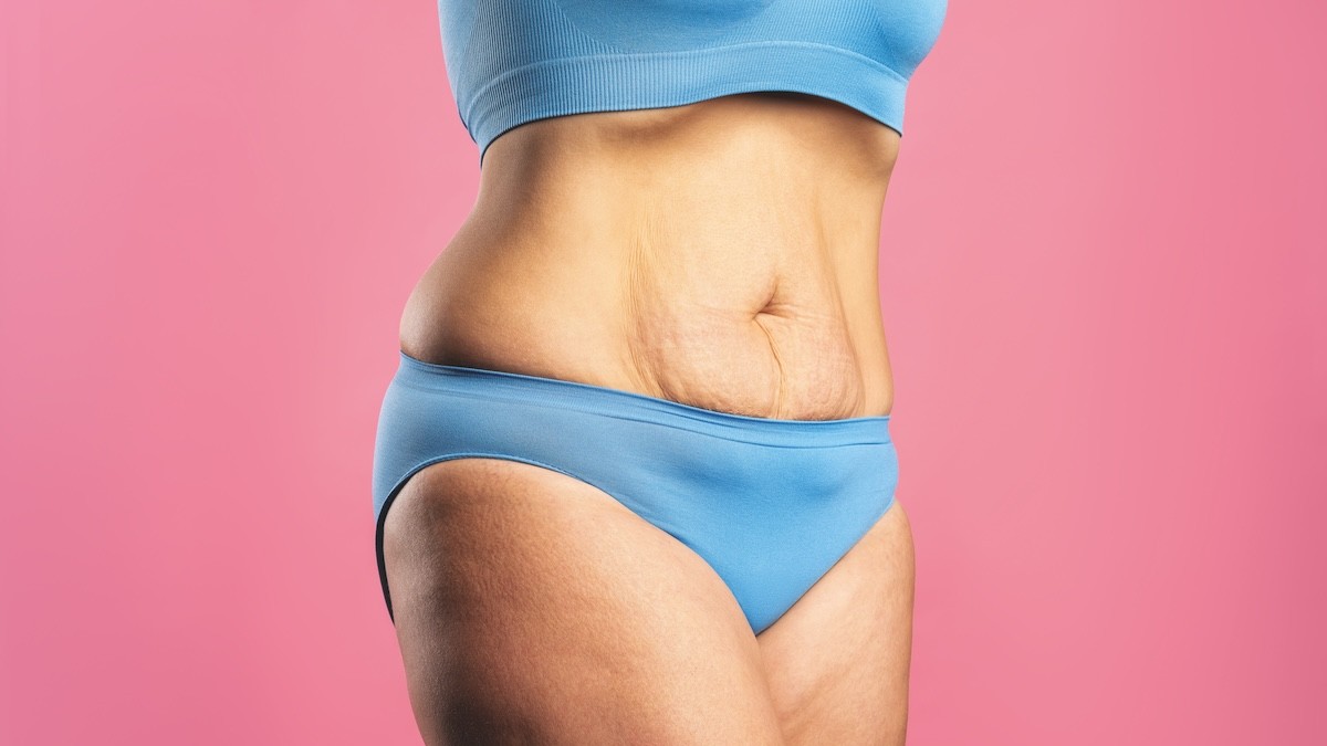 Post-weight-loss skin tightening: how beauty professionals can treat skin laxity after rapid weight loss