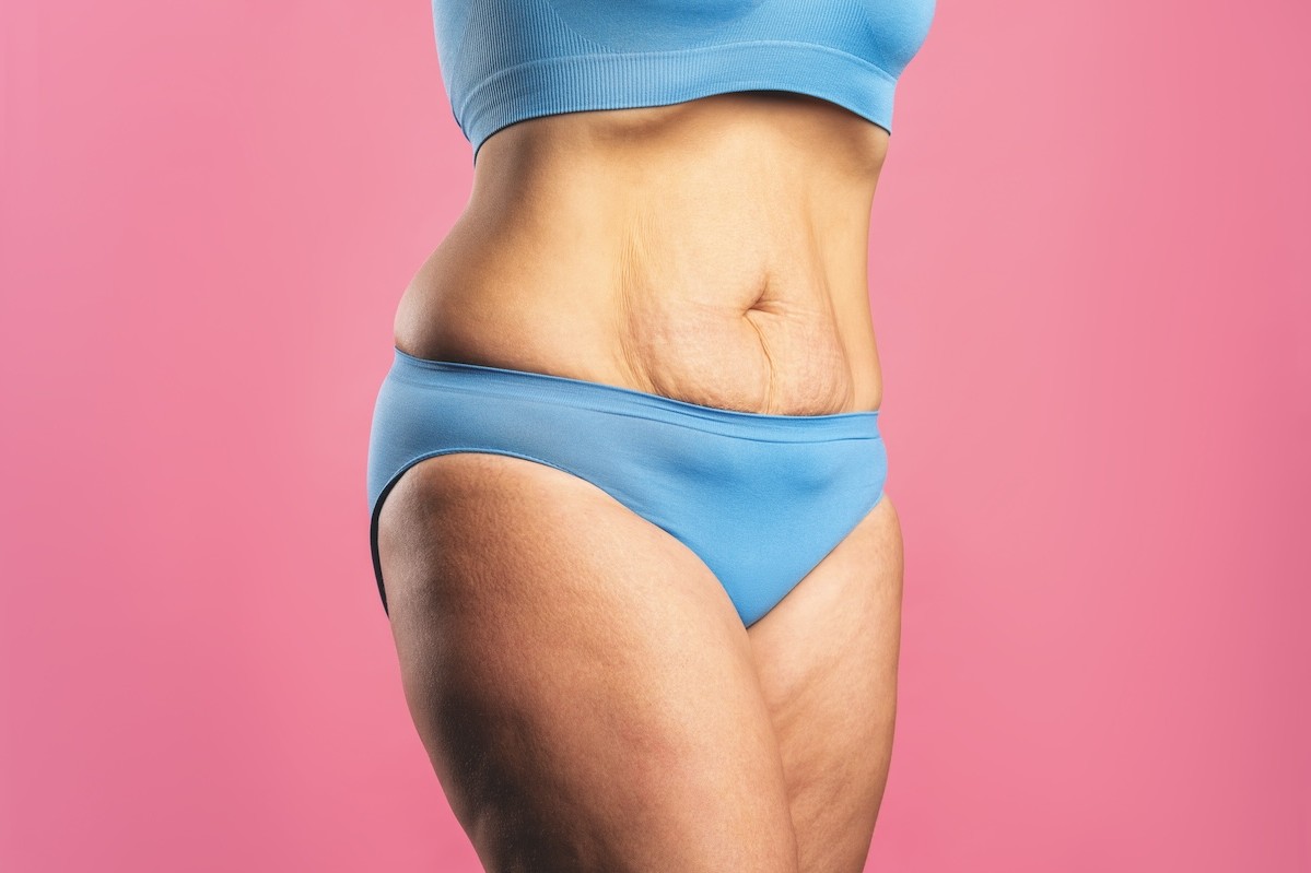 Post-weight-loss skin tightening: how beauty professionals can treat skin laxity after rapid weight loss