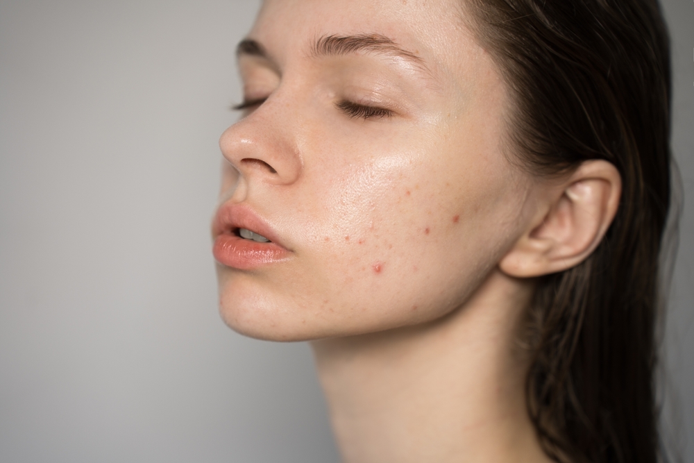 Treating hormonal acne in the colder months