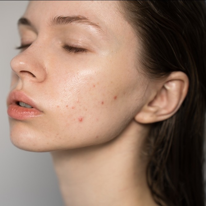 Treating hormonal acne in the colder months