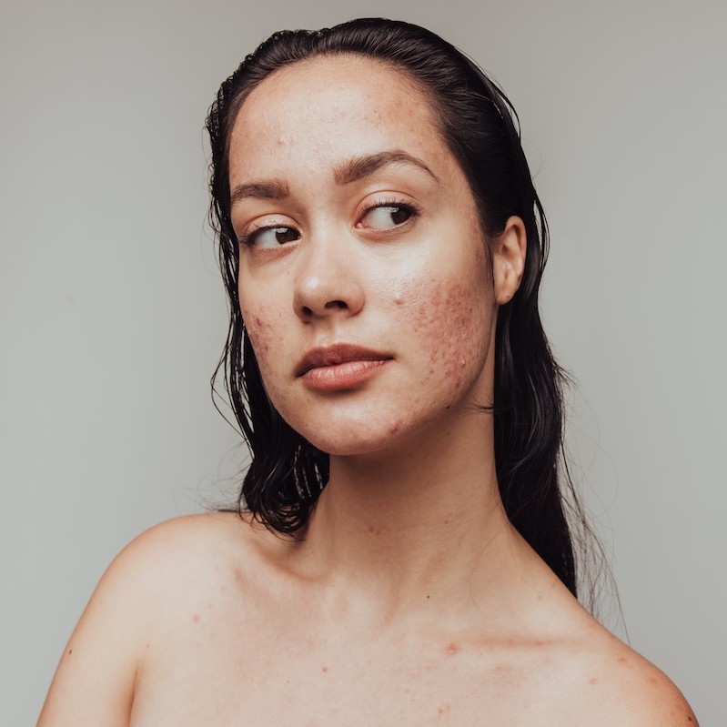 How chronic stress ages the skin and what beauty professionals can do about it