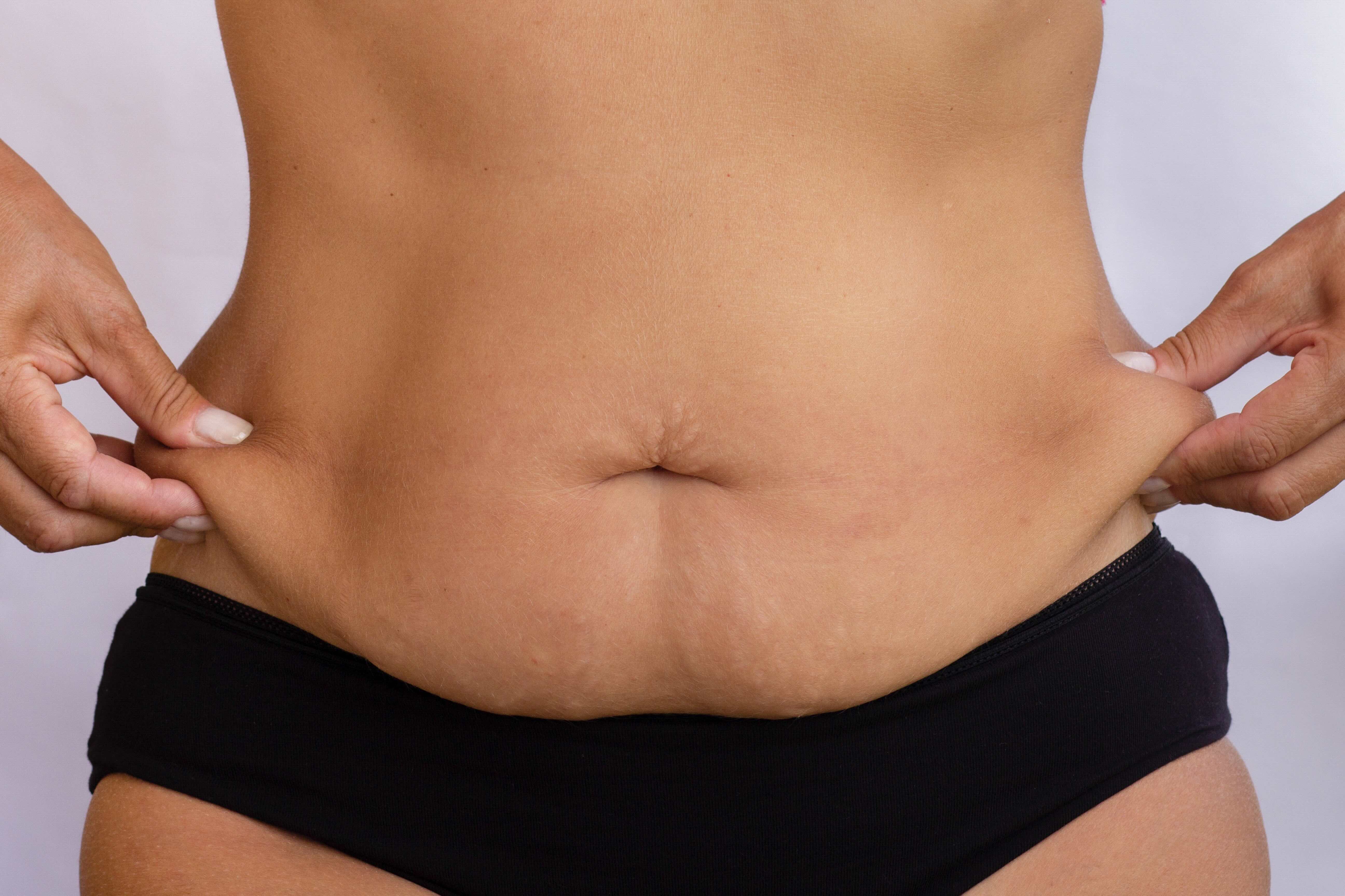 Weight loss drugs and skin laxity: managing the aesthetic challenges of rapid weight loss