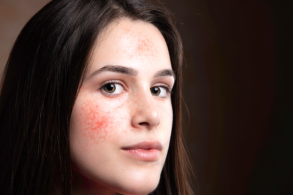 Rosácea y sensibilidad, espejos de lo que pasa dentro del cuerpo