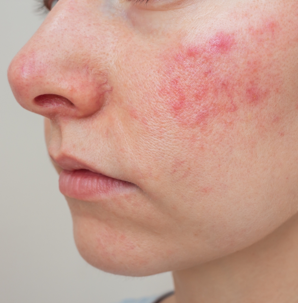 5 rosacea specialists to follow