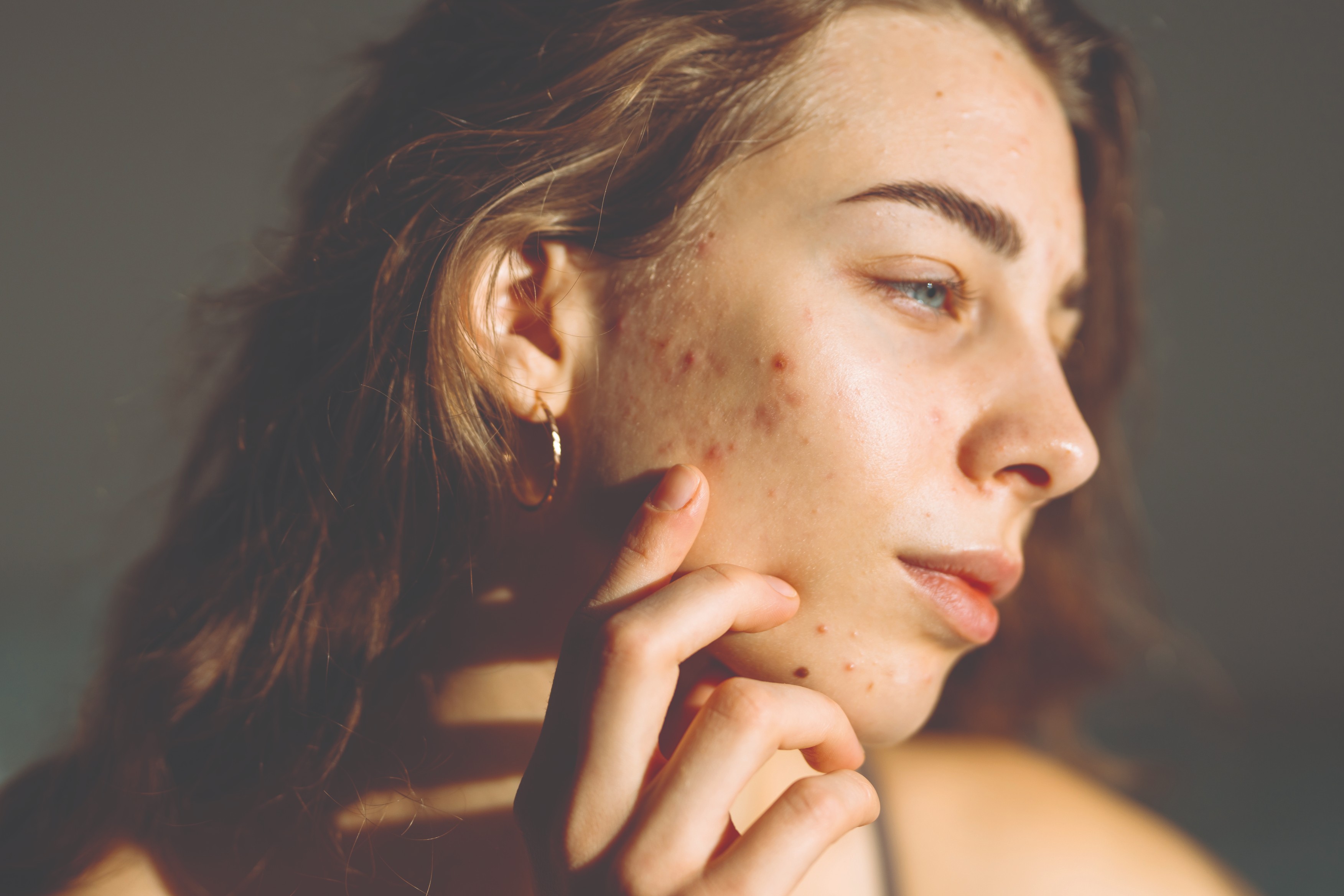 Skin purging – we look at the causes and how to treat it