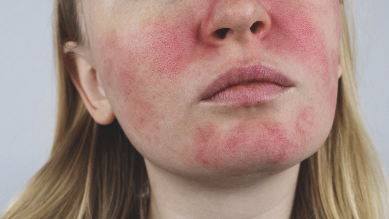 How to treat facial redness: IPL, laser and rosacea considerations