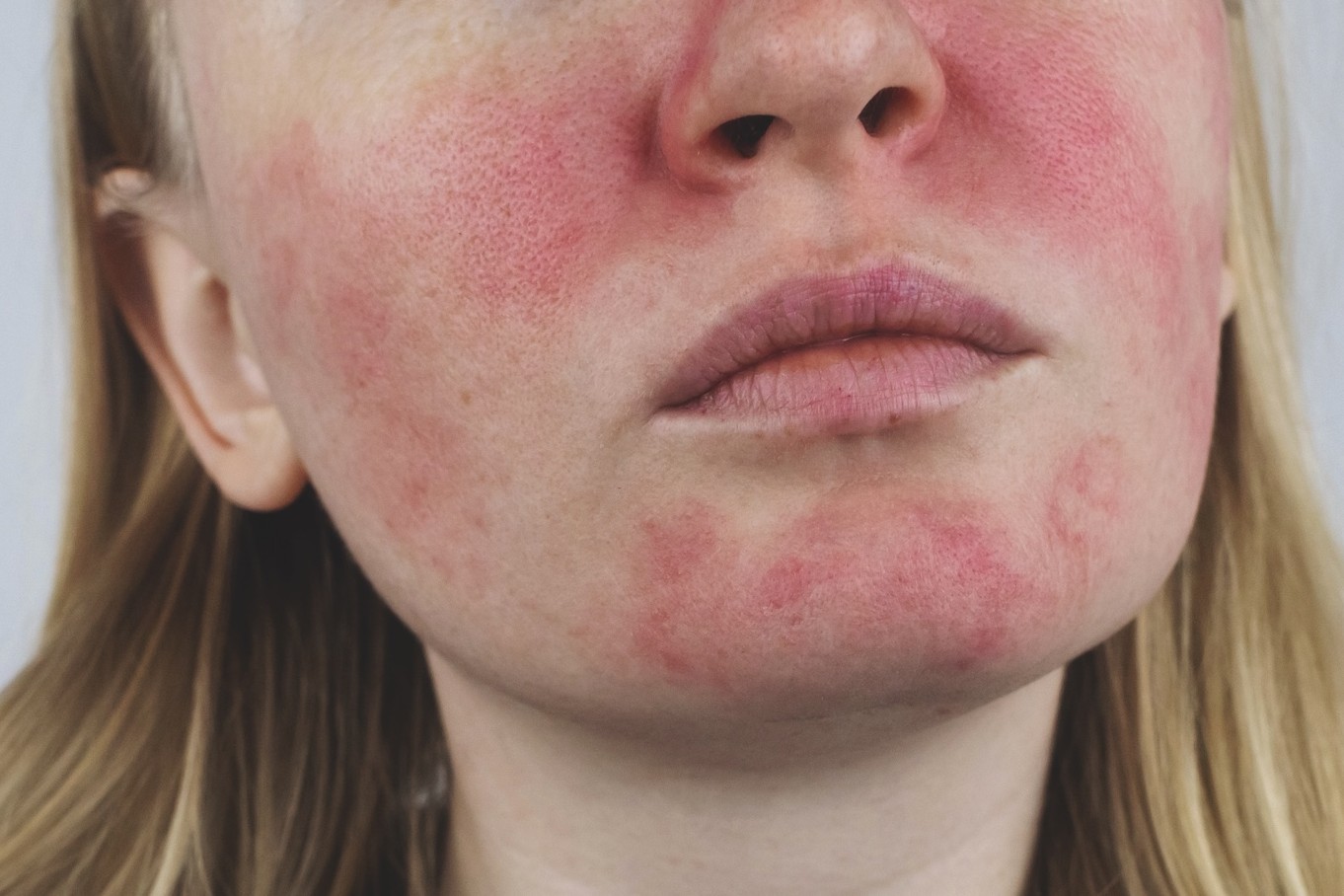 How to treat facial redness: IPL, laser and rosacea considerations