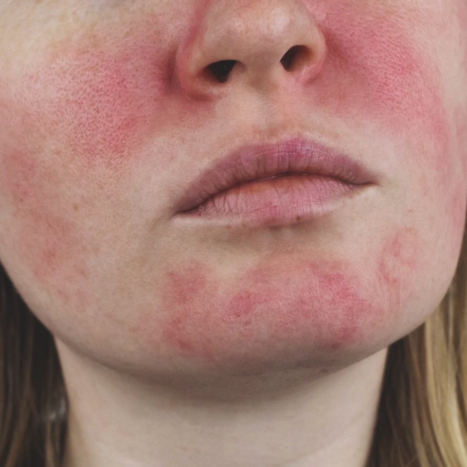 How to treat facial redness: IPL, laser and rosacea considerations