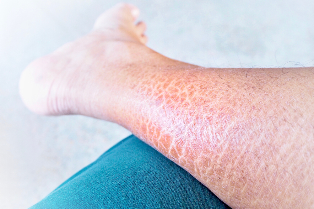 Ichthyosis vulgaris: What you need to know