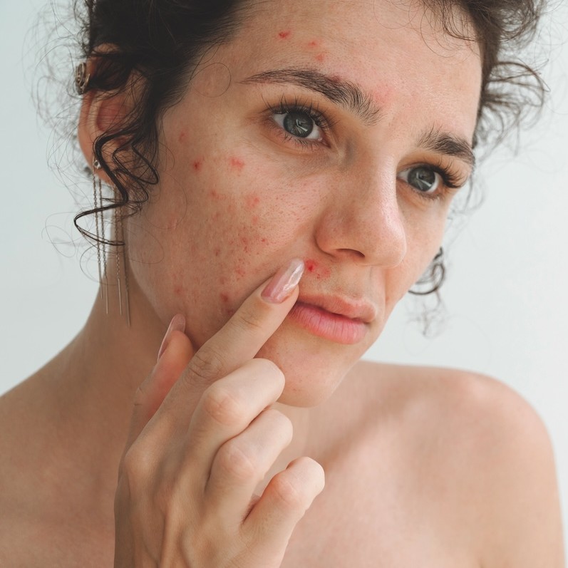 How health and lifestyle factors can affect skin treatment results