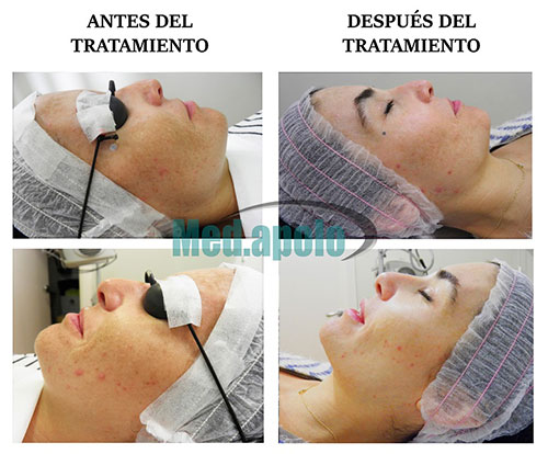 MED.APOLO AUMENTA SU PRESENCIA EN CENTROS DERMATOLÓGICOS CON EL LÁSER ÓPTICO PARA TRATAMIENTOS DE LESIONES PIGMENTADAS Y REJUVENECIMIENTO